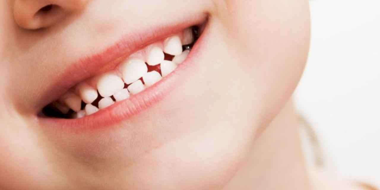 Ağzında yemek tutan çocuklarda dişler daha kolay çürüyor
